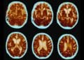 Estudios científicos descubrieron un alimento que puede mejorar el deterioro cognitivo en pacientes con Alzheimer