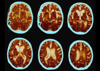 Estudios científicos descubrieron un alimento que puede mejorar el deterioro cognitivo en pacientes con Alzheimer