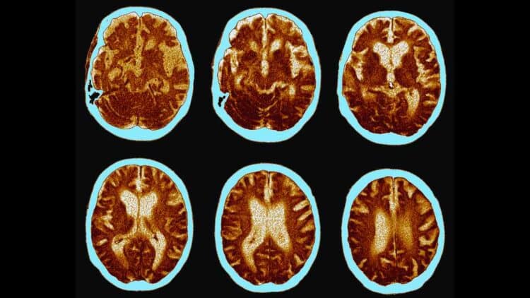 Estudios científicos descubrieron un alimento que puede mejorar el deterioro cognitivo en pacientes con Alzheimer