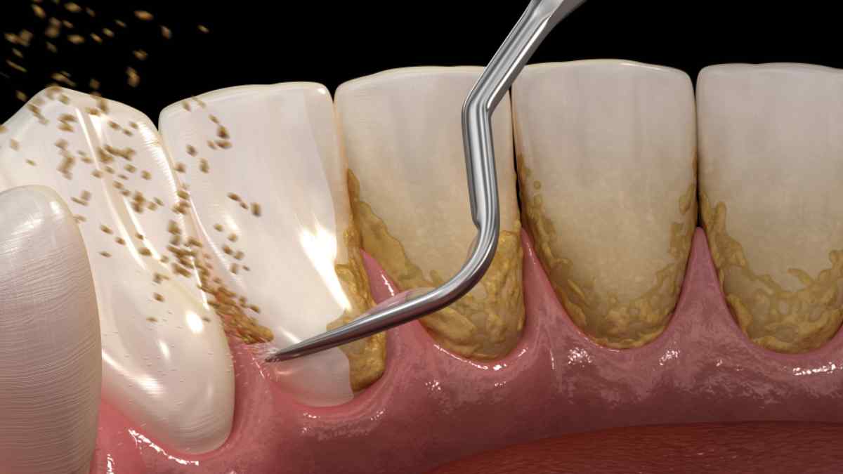 La acumulación de sarro se da especialmente por mala higiene dental.