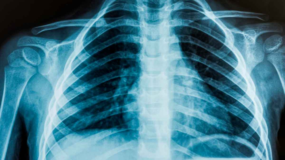 Radiografía de huesos saludables gracias a un alimento barato que ayuda a regular la tensión y reducir el colesterol
