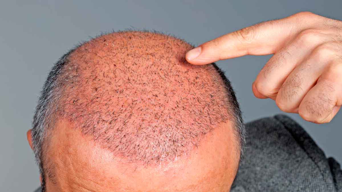 Hombre señalando la cabeza tras un injerto capilar reciente